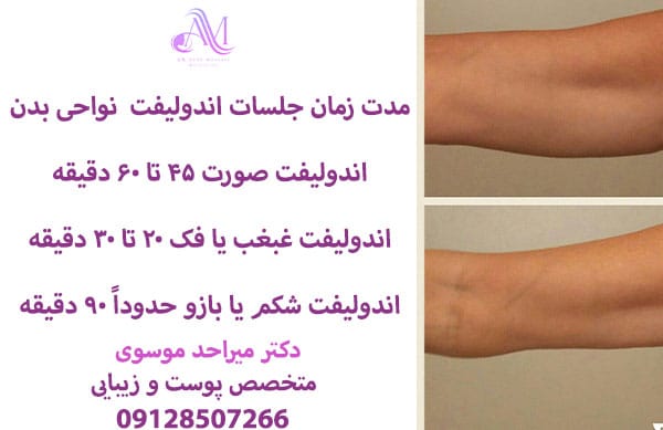 به چند جلسه اندولیفت نیاز است