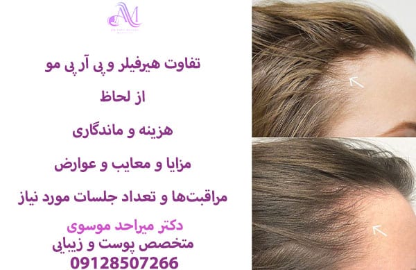 تعداد جلسات موردنیاز برای هیر فیلر و پی آر پی