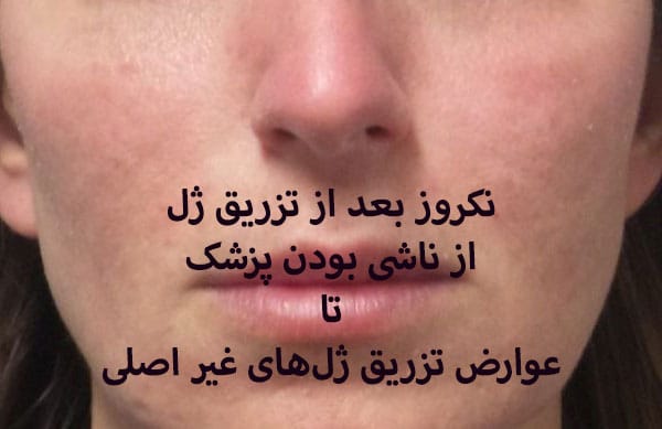 مراجعه به پزشک برای نکروز پس از تزریق ژل