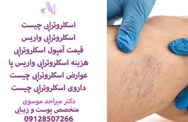 اسکلروتراپی چیست