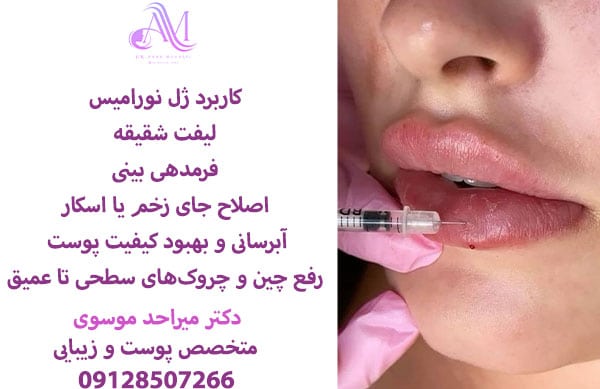 هزینه تزریق هر سی سی ژل نورامیس