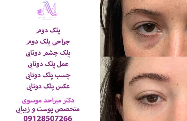 جراحی پلک دوتایی