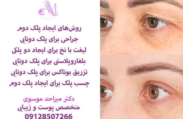 هزینه جراحی پلک دوم