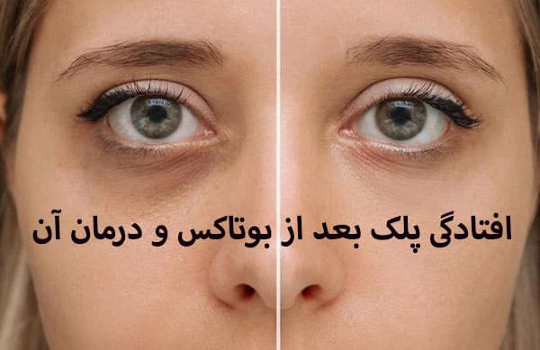 درمان افتادگی پلک بعد از بوتاکس