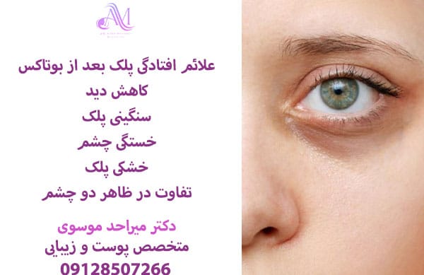 قطره چشمی درمان افتادگی پلک بعد از بوتاکس