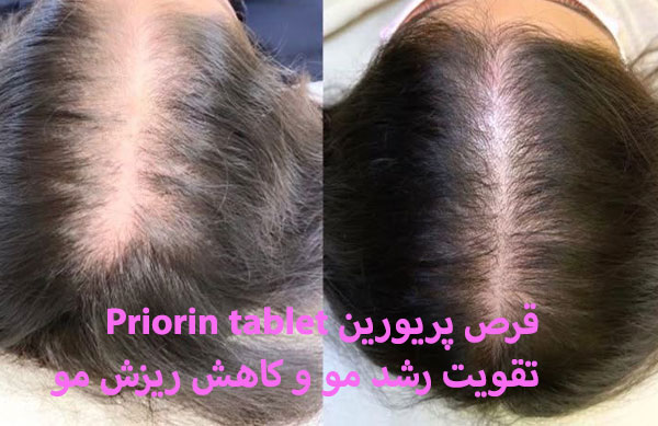 قرص پریورین بهتره یا فیتو
