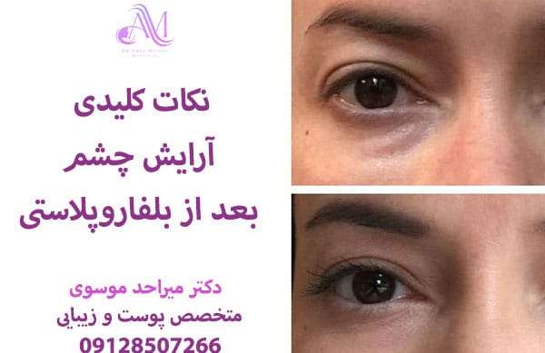 ریمل و خط چشم برای آرایش بعد از بلفاروپلاستی