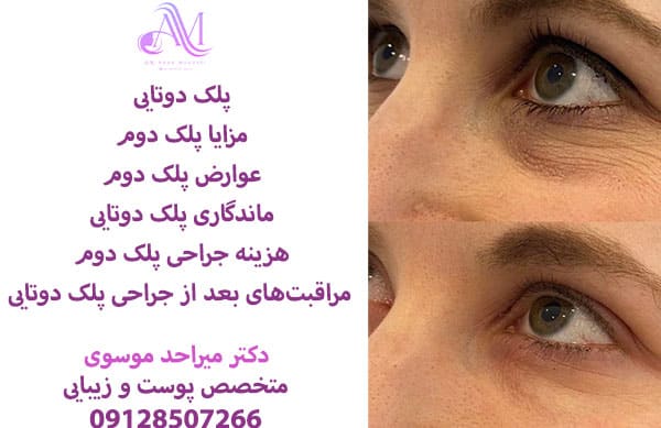 بلفاروپلاستی برای پلک دوتایی