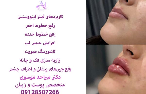 ماندگاری فیلر اینووسنس