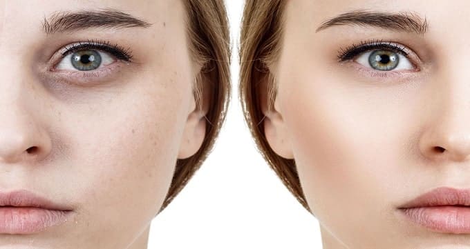 اندولیفت زیر چشم چیست ؟