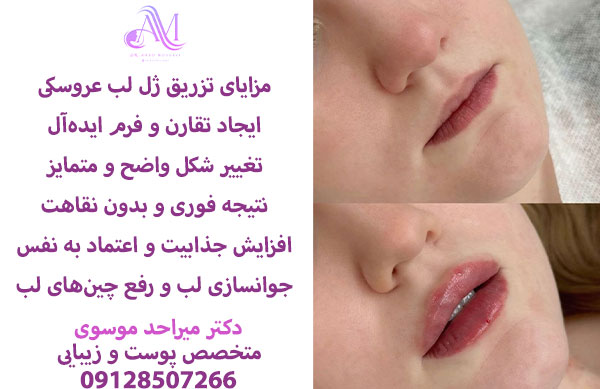 هزینه تزریق ژل لب عروسکی