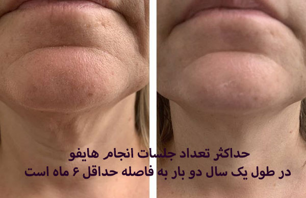 انجام سالانه هایفوتراپی