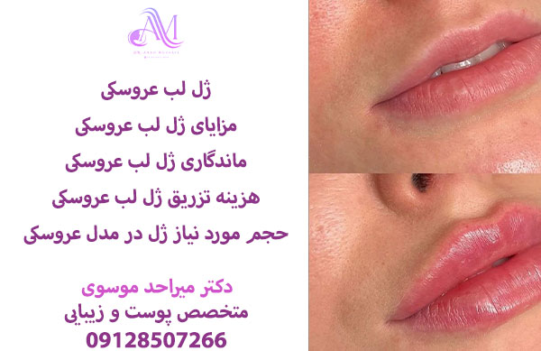 ژل لب عروسکی