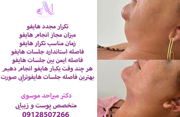 حداکثر تعداد مجاز هایفوتراپی