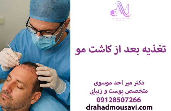 تغذیه بعد از کاشت مو