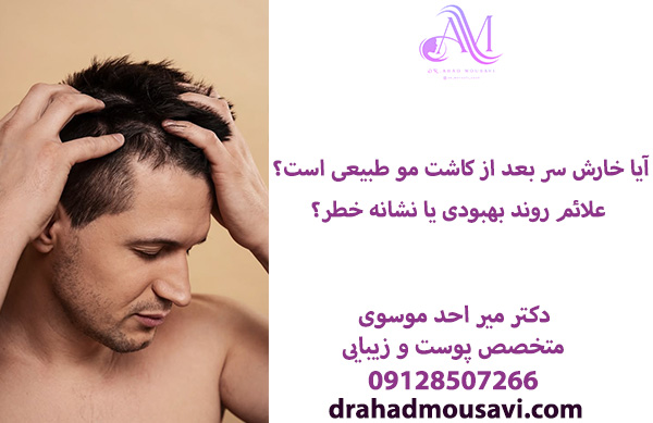 آیا خارش سر بعد از کاشت مو طبیعی است؟