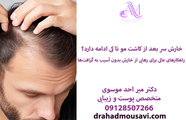 علت خارش سر بعد از کاشت مو