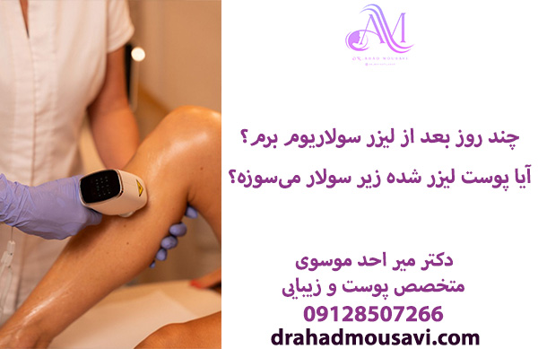 چند روز بعد از لیزر میشه سولار رفت؟